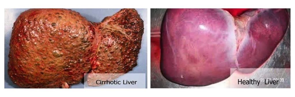 alcolici cirrotic healthy livers